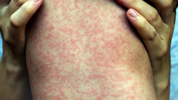 Measles Outbreak in South Carolina&hellip;