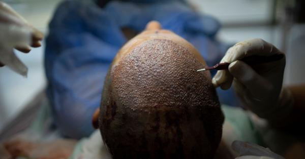 photo of How Turkey Hacked the Hair Transplant Industry image