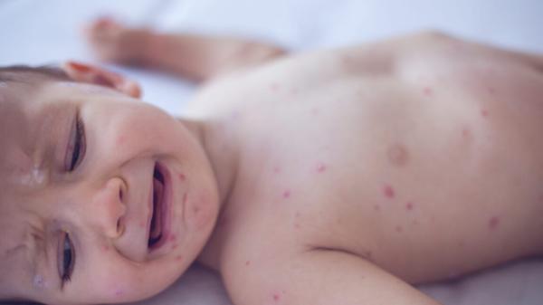 photo of Pennsylvania issues alert on congenital measles—something US hasn't seen for decades image