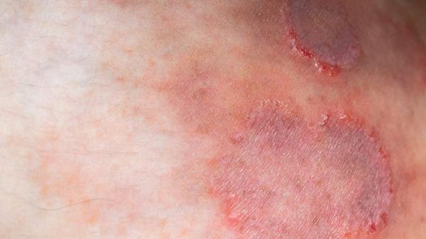 A Drug-Resistant Ringworm Fungus is…