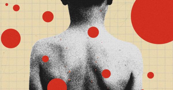 photo of The Backward Logic of Chickenpox Parties image