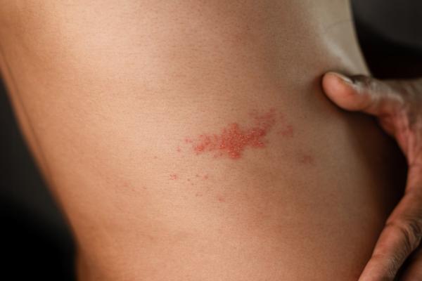 photo of The Shingles Vaccine Could Be a Secret Weapon Against Heart Attacks image